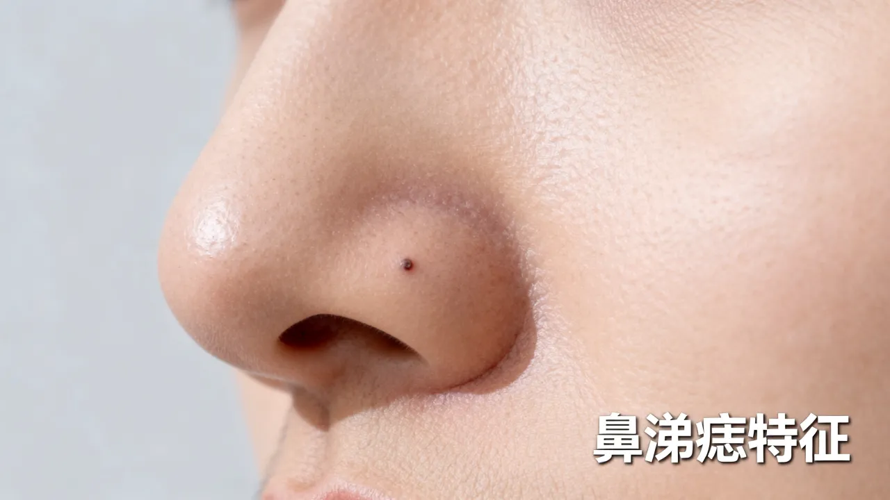 鼻涕痣的命运如何?鼻子上长鼻涕痣代表什么 鼻涕痣的命运如何?鼻子上长鼻涕痣代表什么